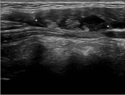 with/without intranodal calcification, abnormal vascularity, and some cystic changes in both