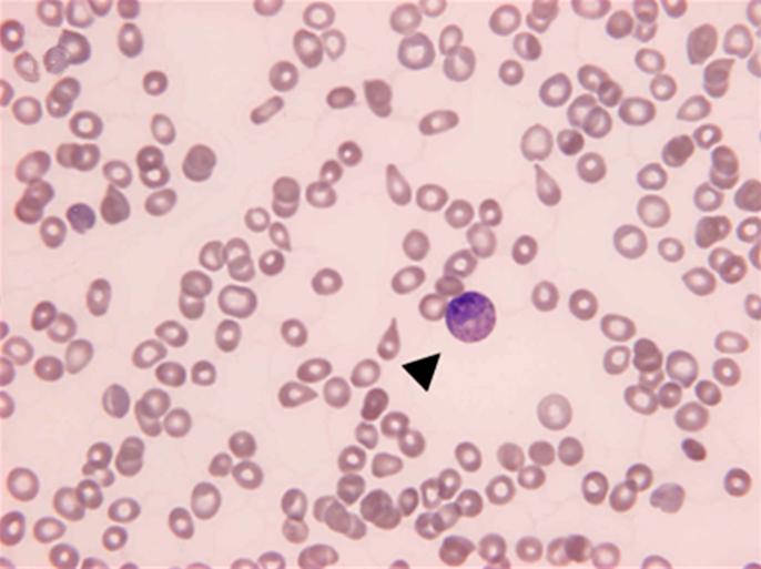 (A, B) Peripheral blood smears showed marked anisopoikilocytosis with tear