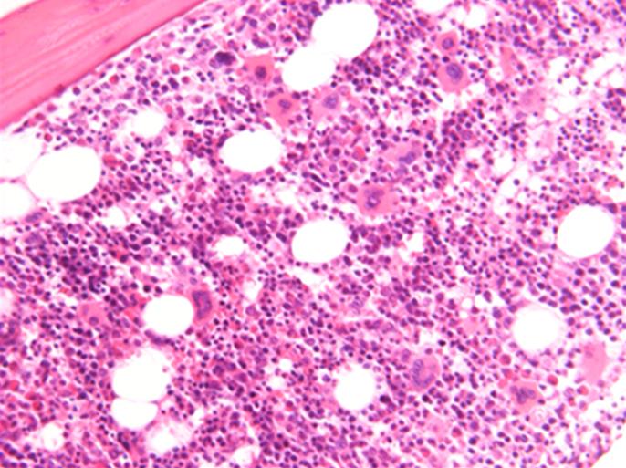 myelodysplastic features (W right-giemsa stain, 1,000).