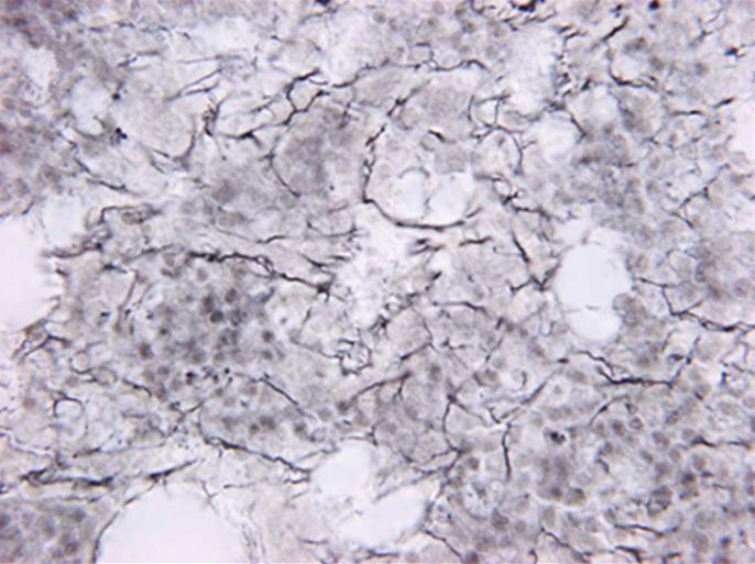 megakaryocytic hyperplasia (Hematoxylin & eosin stain, 400).