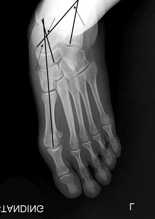 Tae Hoon Lee, et al. Diagnosis of Flatfoot Deformity 3 a b c a d c b Figure 3. Radiographic parameters are shown on weight-bearing lateral radiograph.