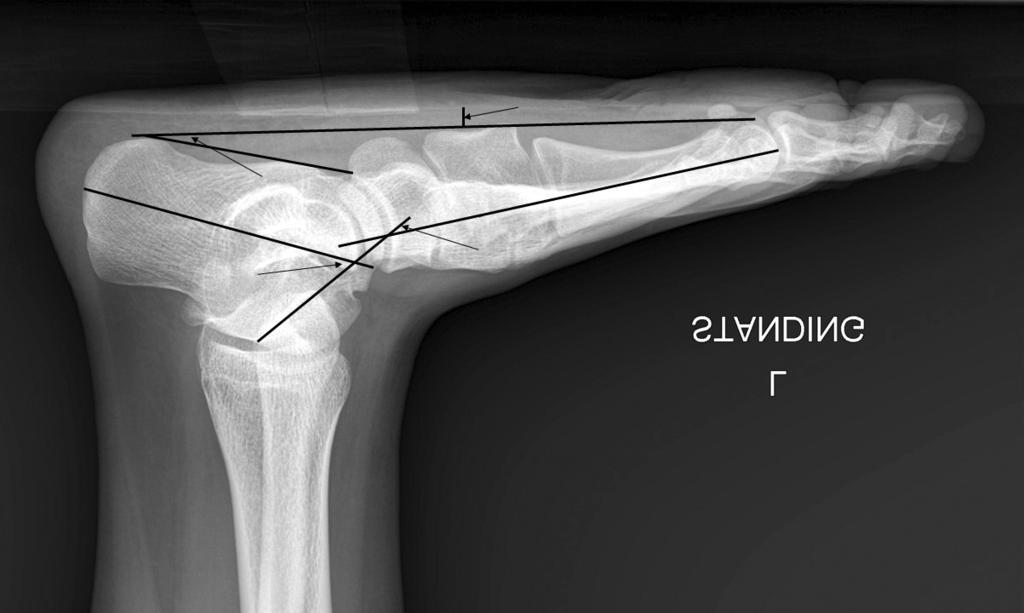 Radiographic parameters are shown on weight-bearing anteroposterior radiograph. a: talo-first metatarsal angle, b: talocalcaneal angle, c: talar coverage angle. 않으면강직성 (rigid type) 으로분류한다.