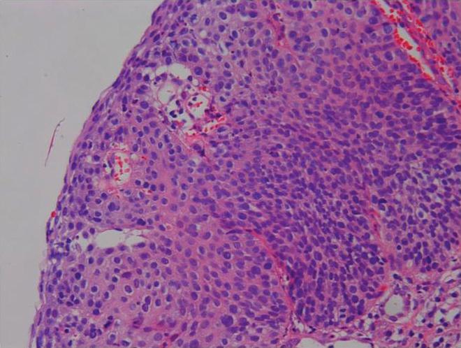It is suggestive finding of carcinoma in situ (H&E stain, 100).