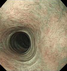 (A) Two weeks after PDT, endoscopy shows circumferential ulceration with mucosal friability.
