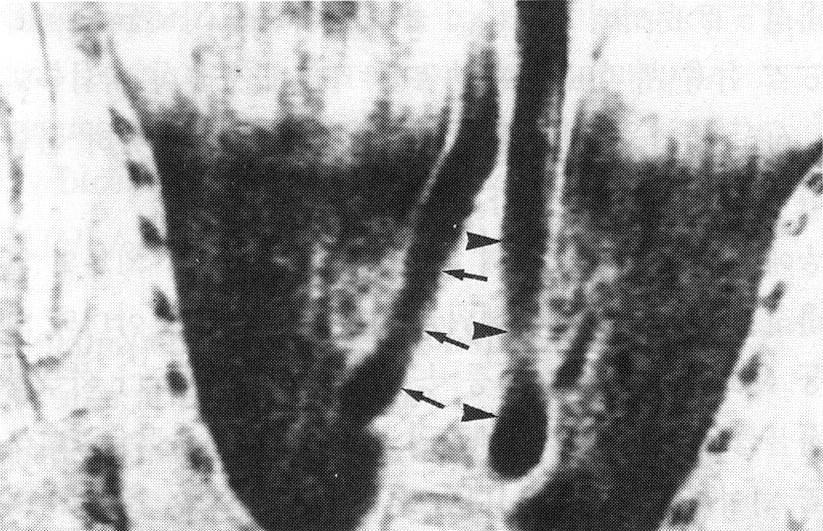 결과 1. 전신정맥환류 1) 하대정맥 2) 상대정맥 2. 폐환류 Fig. 1. Schematic drawings of type of pulmonary venous return in patients with situs ambiguus.