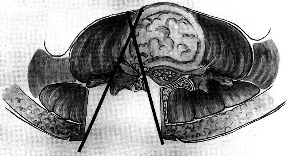 김주영 이승명 신호 Fig. 6. Combined operative procedures of conventional partial hemilaminectomy and discectomy, and intertransverse approach for the foraminal disc herniation.