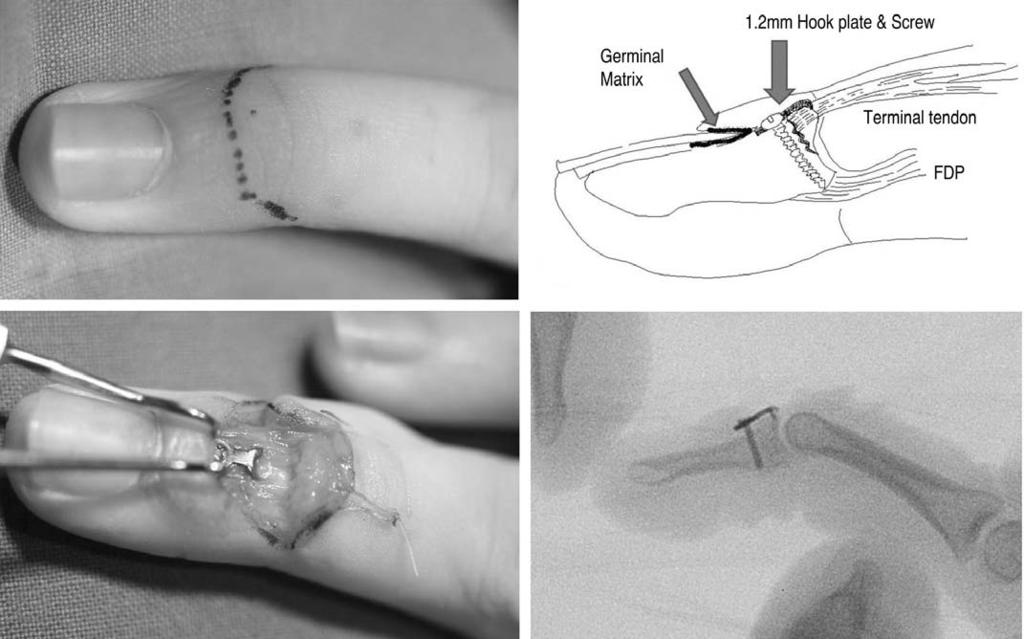 Fig. 2. (A) Skin incision. (B) Illustration of internal fixation. (C) Medical photo of internal fixation with hook plate.