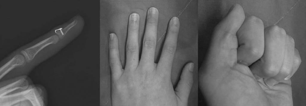 Radiograph of view of finger and medical Photographs showing full flexion and extension 6 months postoperatively. 와동통의유무에따라 4 단계로나누어평가하였다 9.