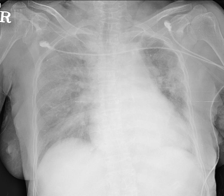 고 안지오텐신 II는혈관수축작용을하는데특히, 콩팥의수출소동맥의수축을유발하여사구체여과율을증 Fig. 2. Chest AP revealed an increased interstitial density over both lung fields with cardiomegaly suggestive acute pulmonary edema(hospital day #8).