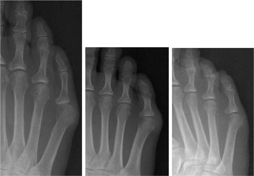(C) Type III is characterized by an increased 4 th -5 th intermetatarsal angle, resulting in a widened forefoot. Figure 4.