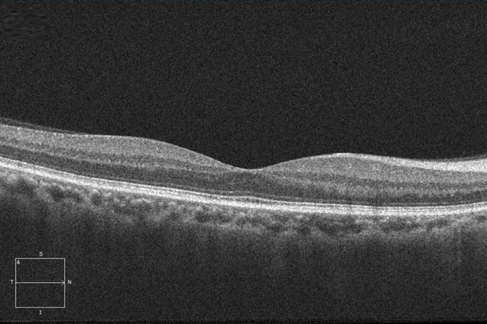 - Hyo Jung Gye, et al. Update in diabetic retinopathy - A B Figure 2. (A) Spectral domain optical coherence tomography: normal fovea.