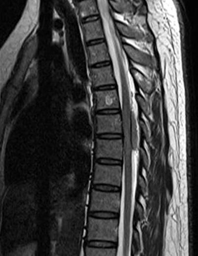 compressed the spinal cord at the 6th and 7th thoracic vertebral
