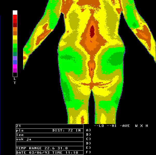 Minimal abnormal T in low back Temperature Measure: 2nd hottest area