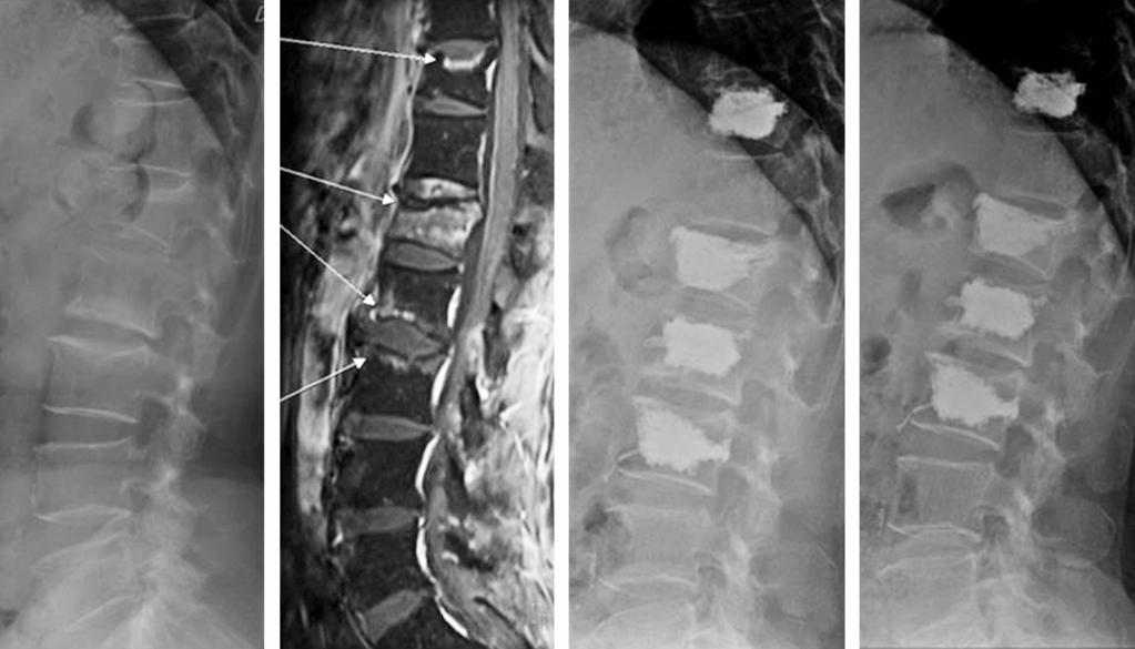 Young-Woo Kim et al Volume 22 Number 4 December 2015 A B C D Fig. 1. A 68-year-old woman experienced multiple osteoporotic spinal fractures after a slip in the bathroom (A).