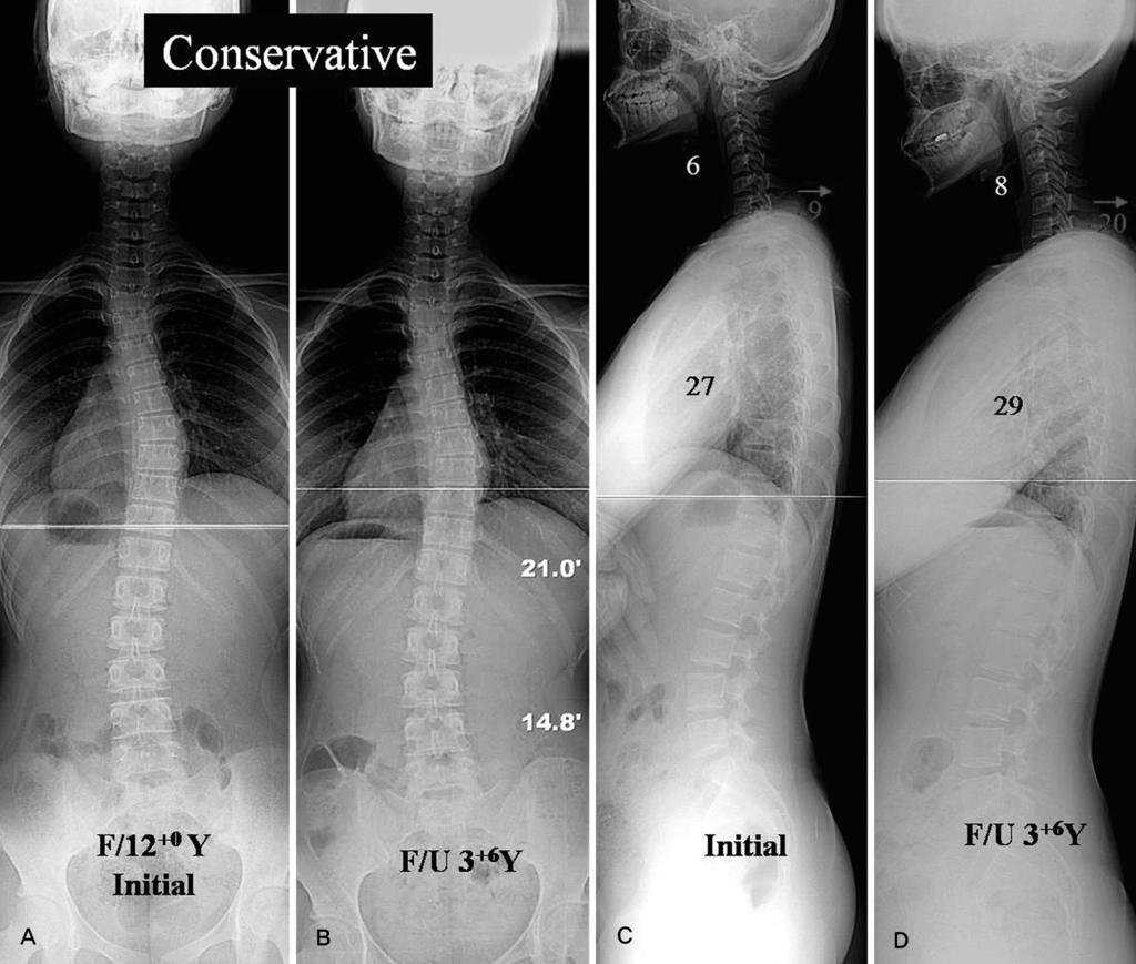 Journal of Korean Society of Spine Surgery Sagittal Curves of Cervical Spine in AIS 는평균 10.3mm 전방에위치하였으며, 체간균형은 15례, 후방불균형 5례, 전방불균형 3례이었다. 흉추후만은평균 35.7 도로측정되었으며, 흉추저후만증은 2례, 정상후만은 21례이었다.