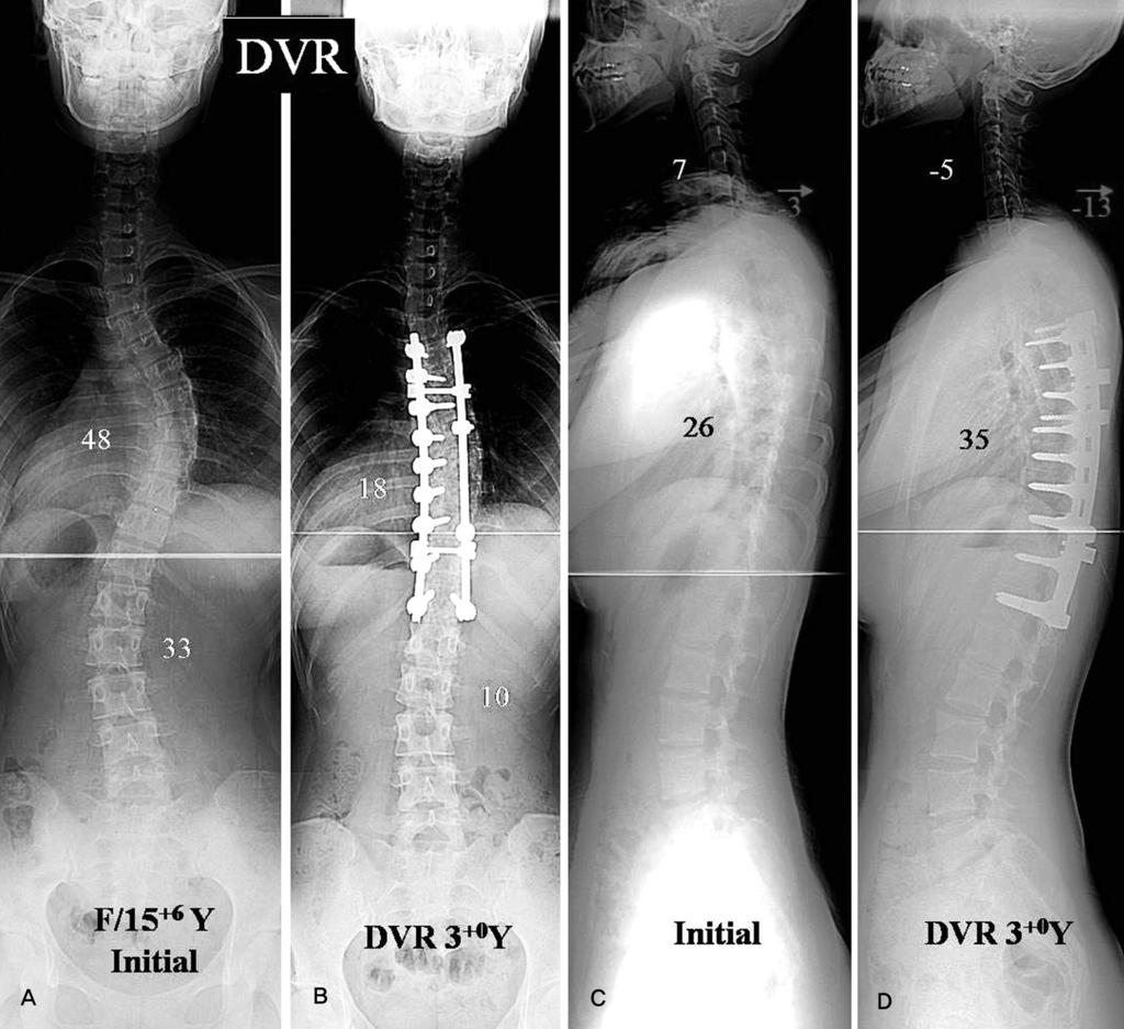 Journal of Korean Society of Spine Surgery Sagittal Curves of Cervical Spine in AIS 이는없었다. 반면, 흉추후만은초진시평균 27.4 도에서술후평균 33.0 도로교정되었으며, 흉추저후만증빈도도초진시 22례 (42.3%) 에서최종추시상 8례 (15.4%) 로감소하였다.