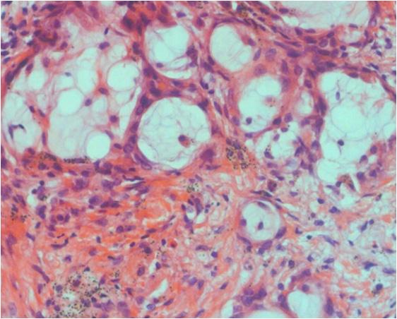 - Myung-Hyun Lee, et al. Hyperamylasemia in lung adenocarcinoma - A B Figure 3. Pathologic features.