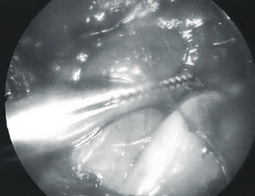 lateral approach (: Parathyroid, B: Lt. recurrent laryngeal nerve). 주소 : 2 현병력 : 2. 과거력, 가족력 :. 신체검사소견 : 2.5 cm. 검사실소견 :.