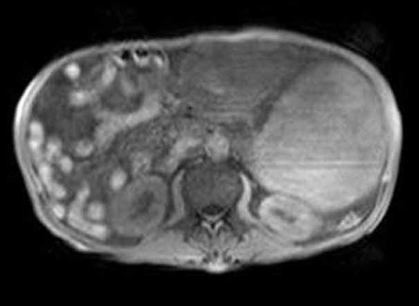 Contrast enhanced axial CT images show a large complex mass at left upper quadrant, with mixed cystic and solid nature, and slight contrast