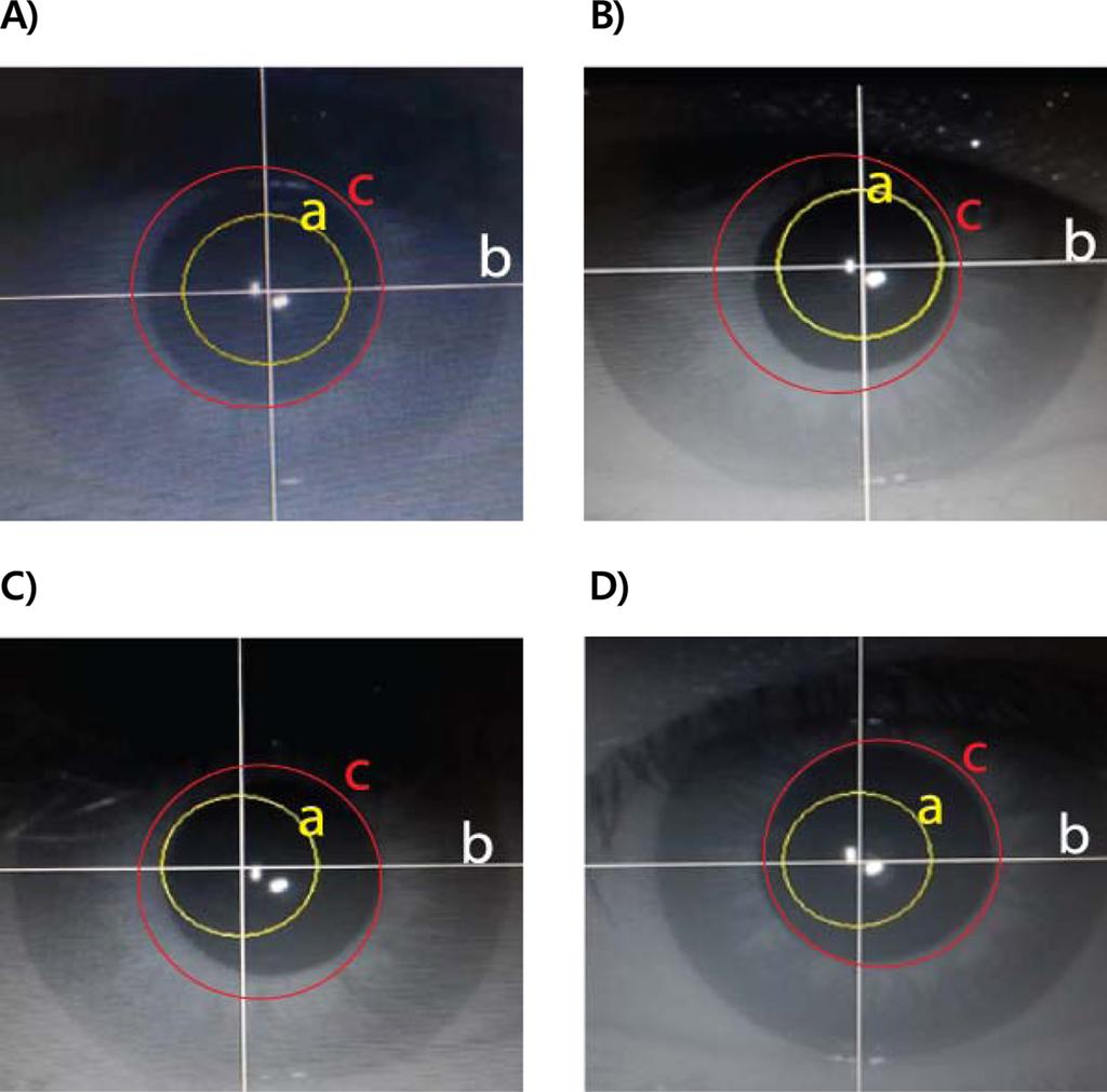 30 Ki Nam Kwon, Sang Hee Park, So Ra Kim, and Mijung Park Fig. 6. The correlation between glare sensitivity and pupil size in the refractive surgery group. A. 6.3 degree, B. 4.0 degree, C. 2.