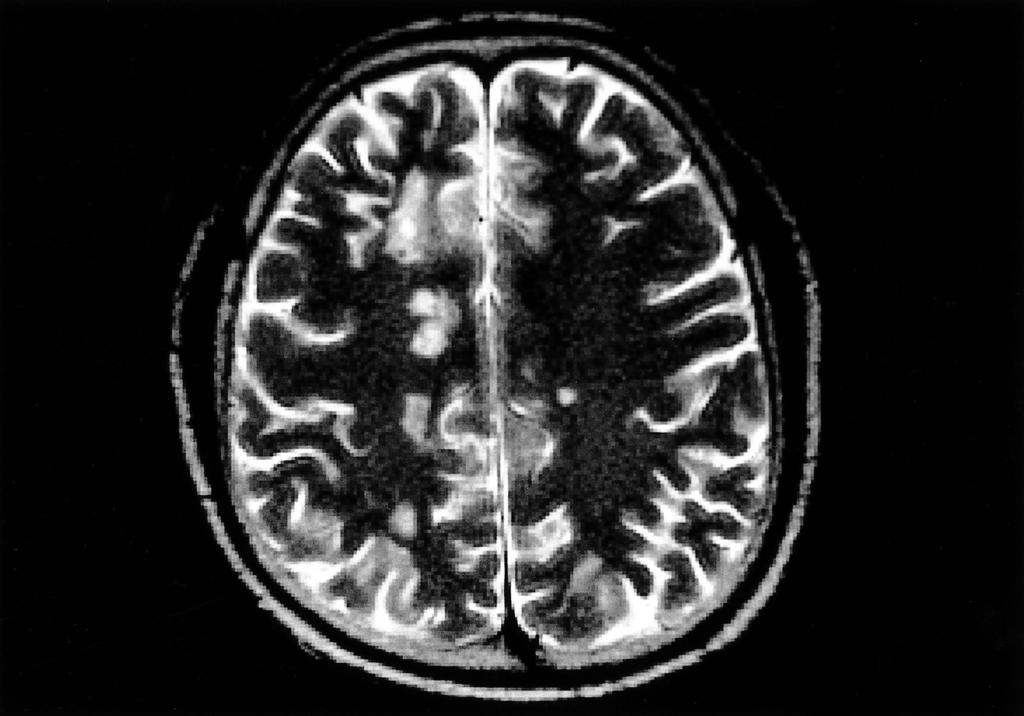 Korean Journal of Medicine : Vol. 59, No. 4, 2000 : 24 16, 1,. 13 cyclosporin prednisolone,.. :, Figure 1. Initial brain MRI.