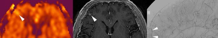 Figure 3. A 54-year-old male who underwent gamma-knife surgery for the right frontal AVM 37 months ago.