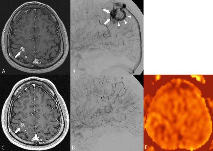 Figure 4. A 28-year-old male who underwent GKS for a right parietal AVM. (A-B) Axial T1-weighted post-contrast image (A) and DSA (B) performed 38 months after initial GKS as a GKS-planning study.