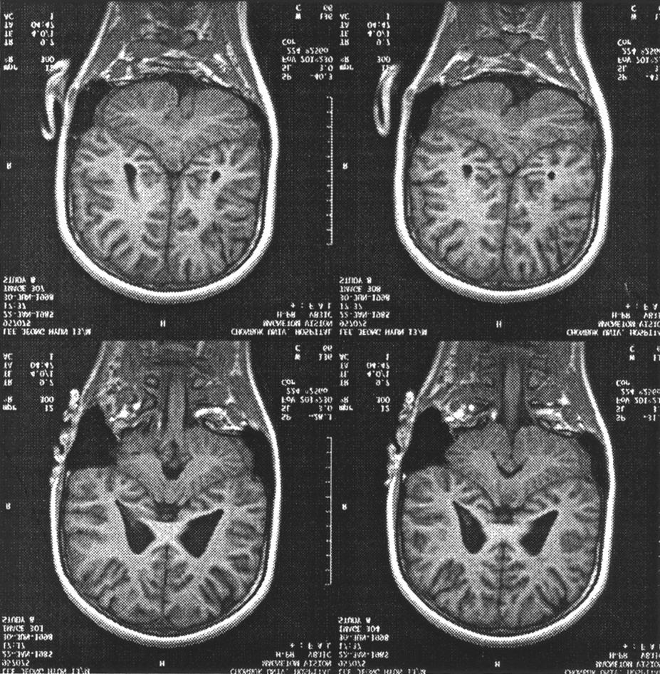 두정엽및후두엽간질에대한수술전략 7. 간질병소절제 Fig. 1. The conventional MRI showing subtle atrophic change in the left superior parietal lobule. 결 1. 임상증상 과 Table 1.