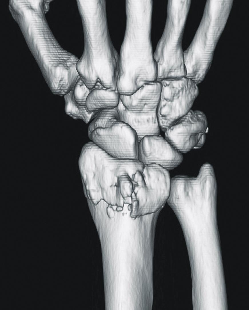 501 7. 골다공증이심한원위요골골절에서골이식및골이식대체물의사용 Fig. 6.