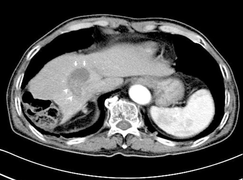 한국산학기술학회논문지 제20권 제3호, 2019 Computed tomography (CT) images show mass in the liver segment 8 with heterogeneous
