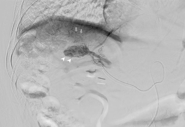 Superior mesenteric artery (SMA) angiogram shows replaced right hepatic artery (D, thin arrows) from SMA and a