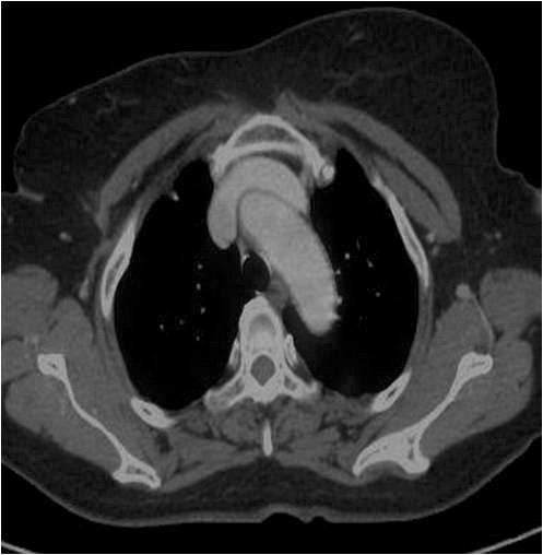 308 Wan Wook Kim, et al. A B C Figure 5. There was no hypermetabolic lesion in the internal mammary area and the other sites on immediate postoperative PET-CT (A).