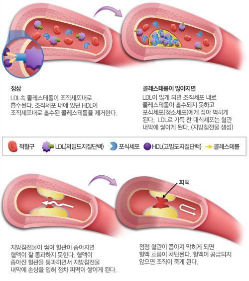 동맥경화과정