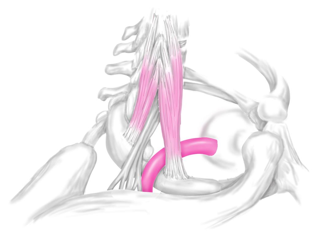 근골격계질환의통증해부학 경늑골 cervical rib 칼럼 1, 2) 사각근간의방해자 : 경늑골 우리몸에서늑골은흉추에만존재한다. 그러나경추횡돌기전방의융기는경부의늑골에해 당하는부분이추골과유합한것이라하여경늑골이라고한다. 이것은 C7 에유합해야하는늑 골이분리되어발생한것이다. 경늑골의형태는제 1 늑골이나흉늑관절과관절을형성하는것에 서부터반흔정도인것까지개인차가크다.