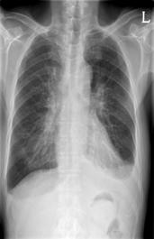 - 대한내과학회지 : 제 87 권제 4 호통권제 650 호 2014 - A B Figure 2. Chest X-ray shows peribronchial infiltration of the right lower lung field and pleural effusion (A), and improved state (B).