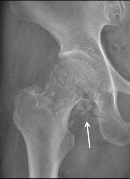 이연수 : 연부조직석회화병변의특징적영상소견 C Fig. 18. Synovial chondromatosis in a 62-year-old woman.. Plain radiograph shows multiple calcifications of right hip (arrow).