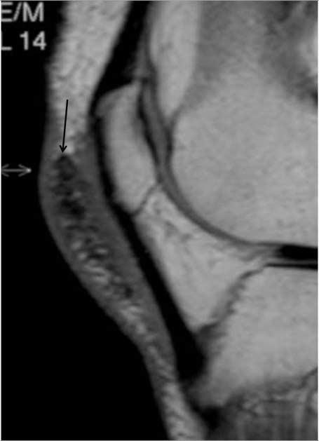 Sagittal T2-weighted MR image of knee shows several dark signals (arrow) in the prepatellar subcutaneous area.