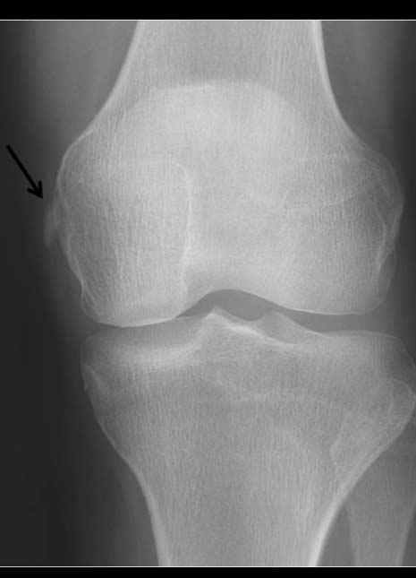 되고관절주위골다공증이없는것이류마티스관절염과의감별점이다 (Fig. 10). 불규칙한또는구름같은방사선고밀도부위 (radiodense area) 로보이며, 그외연골석회화증이 5~32% 에서보인다 (8).