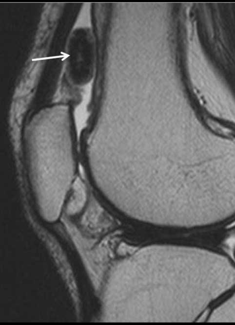 . Sagittal fat suppressed T2-weighted MR image demonstrates well defined, a lobulated mass in the medial midfoot including calcification (arrow).