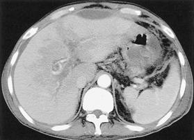 nd also a large central area of hypoperfusion in the liver was noted. Figure 4.