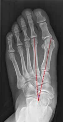 Prevention and treatment of hallux valgus 의학강좌 A B C D Figure 1. Foot standing anteroposterior radiographs of the left foot of a 34-year-old woman.