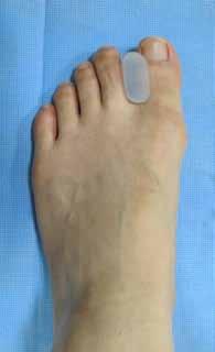 Kim JH 무지외반증의치료 A B C Figure 2. Foot orthotic devices for hallux valgus. (A) Toe-separator. (B)Toe-separator combined with bunion protector. (C)Bunion splint. 상, 후족부축영상을통해, 동반된소족지및후족부변형유무에대해서도살펴봐야한다.