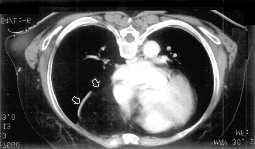 (B) Chest CT scan showing about 6 7