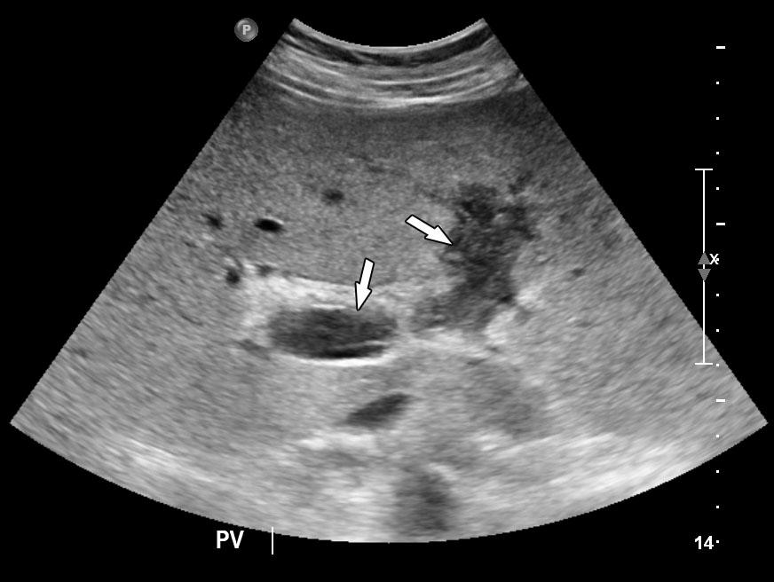 Abdominal CTshows an abnormal low-density lesion indicative of a filling defect (thrombus) in the portal vein (arrow) and