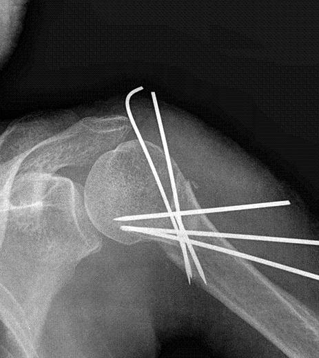 근위상완골골절치료의최신지견 97 (fixation) 에는끝에나사홈이있는 K 강선 (end-threaded Kirshner wires) 혹은유관나사 (cannulated screws) 를이용한다 23). 시술후에는투시경하에서정복및고정의안정성을꼭확인하여야한다.