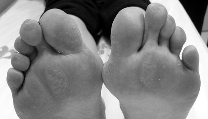 정홍근ㆍ김태훈 : Common Foot and Ankle Disorders (forefoot), 중족부 (midfoot), 후족부 (hindfoot) 로나뉘어지며각각의관절이유기적으로연결되어복합적으로기능을하기때문에환자에대한세밀한접근및감별진단이필수적이다.