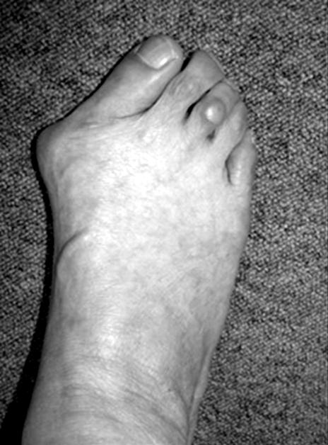 정홍근ㆍ김태훈 : Common Foot and Ankle Disorders 는 중족골의 좀 더 근위부의 시술(근위 중족골 절골 있으며, 중등도 이상의 무지외반증 교정에 사용되고 술,