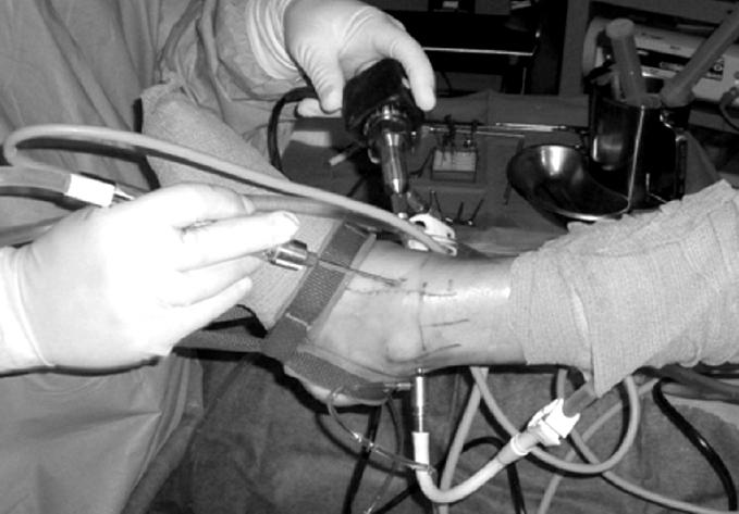 정홍근ㆍ김태훈 : Common Foot and Ankle Disorders Table 1. MRI staging for OLT (From Anderson, I. F., K. J. Crichton, et al.