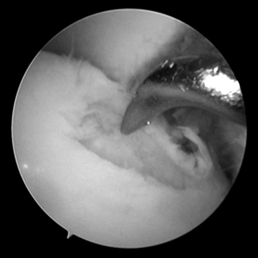 대한류마티스학회지제 17 권제 4 호 2010 Fig. 6. (A) Arthroscopic view of the flap tear in the OLT. (B) Arthrosopic microfracture procedure for stimulation of the subcondral bone marrow.