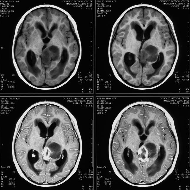 뇌종양 (brain tumor) Malignant ( 악성 ) Glioma